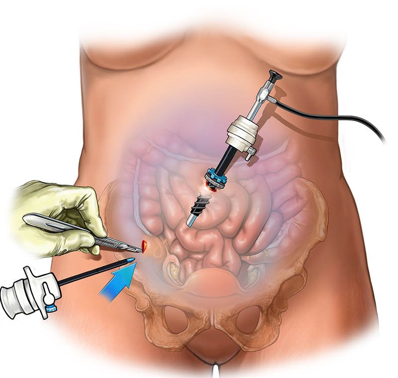 Laparoscopic surgeries | William Hospital Office Nagercoil